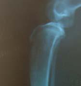 haftada alınan radyografilerde kortikal kabukta tamamen kemikleşmenin sağlandığı gözlenmiştir.