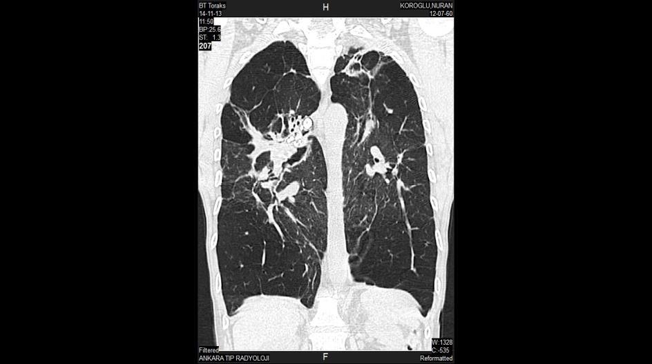 Evre 4-fibrotik sarkoidoz, pulmoner