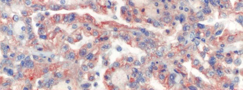 Şeffaf hücreli tümörlerde makroskopik tümör çaplarının ortalaması 6,5±3,33 cm dir.
