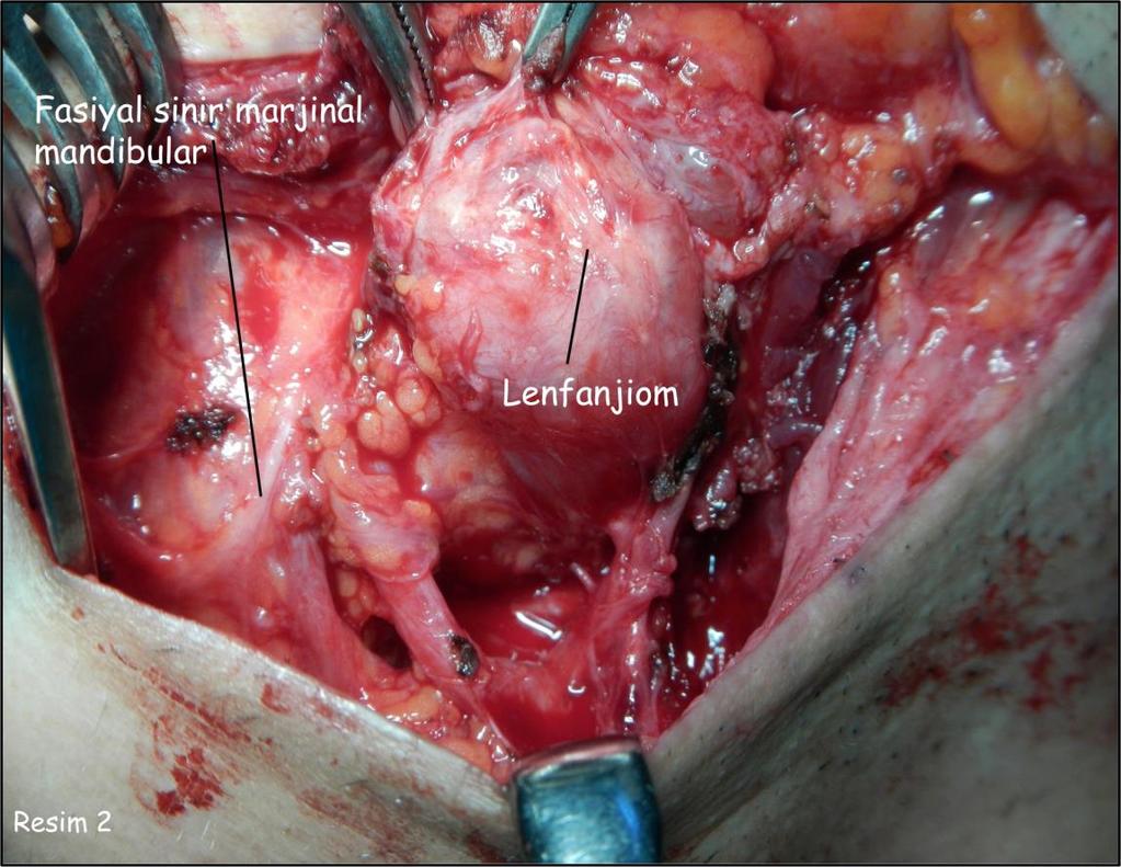 İnfrahyoid yerleşimli lenfanjiom kitlesi, internal juguler ven ve sternokleidomastoid kas lateralinde, arka