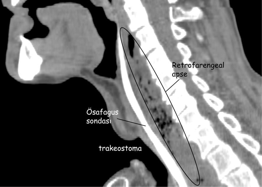 Retrofarengeal/retroözafageal apse: Aşağıda