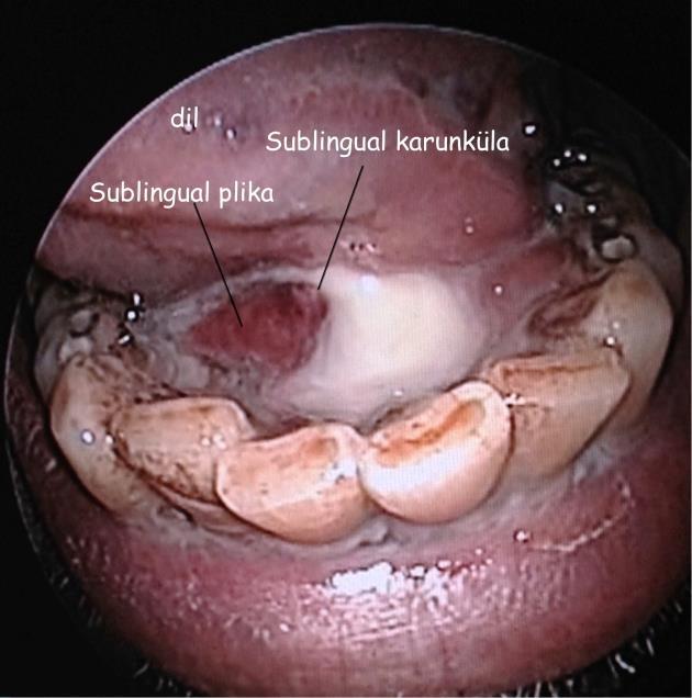 Submandibular sialadenit: Tekrarlayan akut pürülan sialadenit hastası.