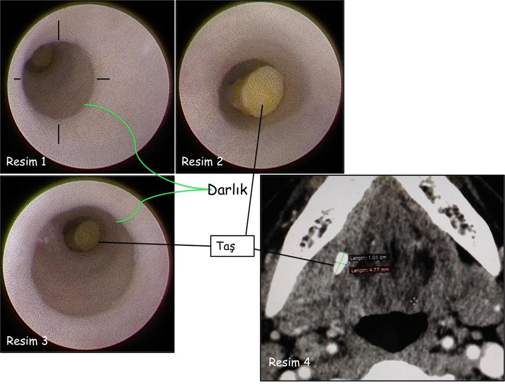 Ağız içinden Submandibular kanala 1 mm çapında bir endoskop ile girilmiştir.