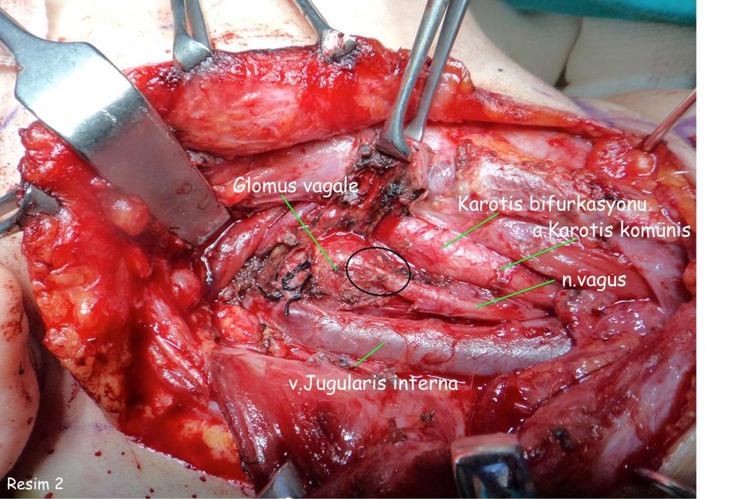 Glomus vagale: Sağ boyunda karotid üçgen içinde palpe edilen kitle.