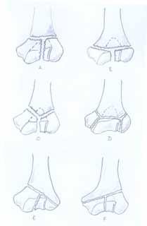 Milch Tip 1: Lateral troklear çıkıntı sağlam Milch Tip 2: Lateral troklear çıkıntı boyunca uzanan kırıklar Çift Kolon Kırıklarında Jüpiter sınıflaması (Şekil 6): Şekil 6.