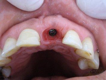 1 hafta sonra, vidalı geçici abutment (Straumann, Basel, İsviçre) üzerine hazırlanan akrilik geçici kron, geçici siman (Cavex Holland B.V.