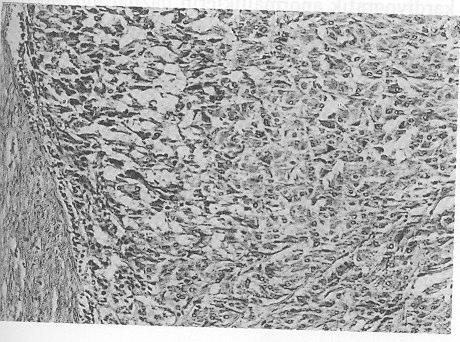 Serbest T 4 : 0.74 (0.8-1.9 ng/dl), TSH: 10.4 (0.4-4.0 uiu/ml), Kalsitonin: 150 pg/ml (normal: <50.0) idi. Feokromositoma ön tanýsý ile hastaya cerrahi eksplorasyon planlandý.