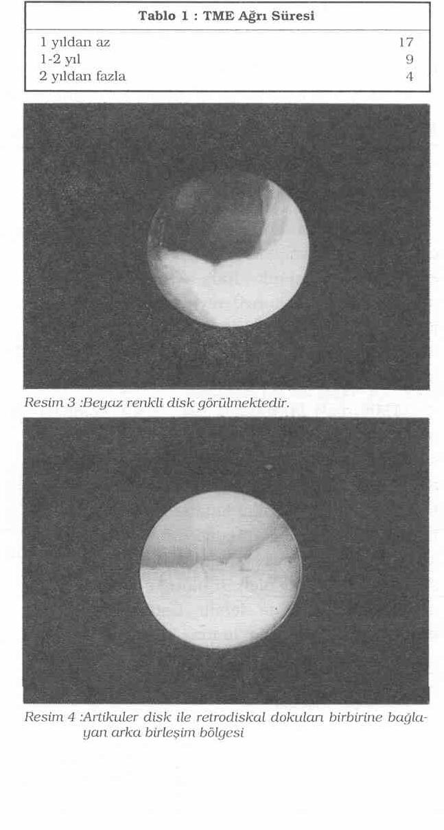 Dr. Metiı Önerci Resim 2 :TME frontal kesiti (1) medial kapsül (2) medial diskal bağlantı (3) disk sentral kısmı (4) lateral kapsül (5) lateral diskal bağlantı Lateral pterigoid adalenin iki kısmı