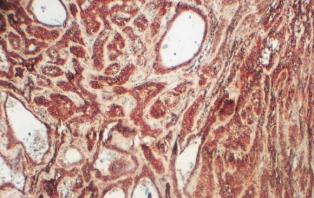 Tart flma 1970 y l nda Eneroth un genifl serilerinde, parotis tümörlerinin %96 s gerçek tükürük bezi tümörü olup, bunlar n %78 i benign pleomorfik adenomlard r. Malign lezyonlar n insidans %17 dir.