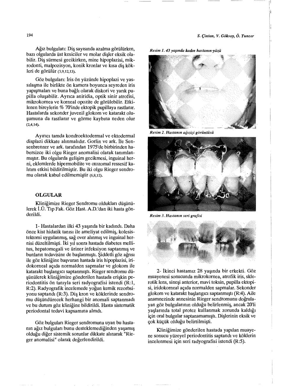 194 S. Çintan, V. GÖksoy, Ö. Tuncer Ağız bulguları: Diş sayısında azalma görülürken, bazı olgularda üst kesiciler ve molar dişler eksik olabilir.