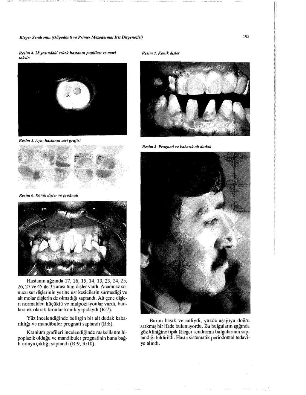 Rieger Sendromu (Oligodonti ve Primer Mezodermdi İris Diagenezisi) 195 Resim 4. 28 yaşındaki erkek hastanın pupillası ve mavi toksin Resim 7. Konik dişler Resim 5. Aynı hastanın seri grafısı Resim 8.