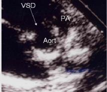 Ao: Aort, PA: Pulmoner arter. c) Perimembranöz-trabeküler VSD: Sağ ventrikül trabeküler kesimine açılan perimembranöz defektlerdir.