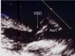 Müsküler defektler: Sağ ventrikülden bakıldığında kenarları tamamen müsküler dokudan oluşan bu defektler, sağ ventrikülde açıldıkları bölgeye