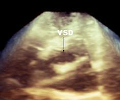 VSD: Ventriküler septal defekt.
