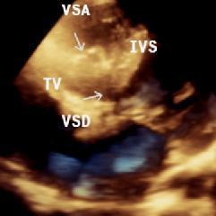 a b Şekil 4.6.3. Ventriküler septal anevrizması olan VSD nin 3-B EKO ile görüntülenmesi.