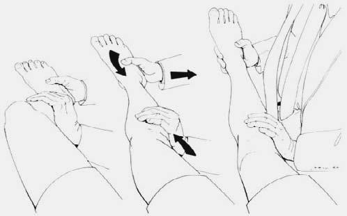 Resim 7: Hughston jerk testi Losee testi: Hasta supine pozisyonunda yatar. Diz 45 0 fleksiyonda bacak dış rotasyonda tutulur. Diğer elle uyluk kavranır ve başparmak fibulanın posterioruna konur.