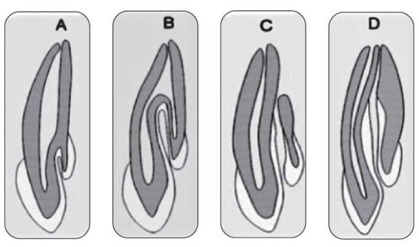 anomali gösteren bu gibi dişlerin kron-kök şekli ve boyutlarında fazlaca çeşitlilik görülmekte 1 ve radyografik muayenede diş içinde diş olduğunu anımsatan bir görüntü izlenmektedir.