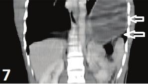 216 Acil Serviste Toraks BT / Thorax CT in Emergency Department ise damar ve sinir hasarına yol açabilir. Sternoklavikuler eklemde anteriora dislokasyon daha sık izlenir.