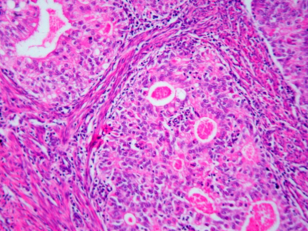 Klasik endometrioid tipteki tümörlerin büyük bölümü (7/3) iyi diferansiye (grade I) iken; nonendometrioid karsinomlar, tanımlandıkları gibi grade III tümörlerdir.