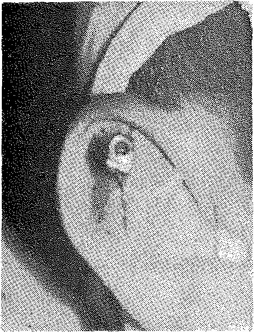 Kulak ön yüzde belirlenen ve oluşturulacak antiheliks boyunca batırılan bir hipodermik iğnenin arka ucu kulak arkasında metilen mavisi ile boyanıp iğne çıkarıldı (Şekil 5), Böylece perikondrium ve