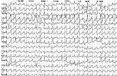 Matur ve ark. Farkl etiyolojik nedenlere ba l nonkonvulziv status epileptikus 29 fiek L 1 Her iki hemisferde devaml, orta ve yüksek amplitüdlü, 3-3.5 Hz jeneralize diken-dalga deflarjlar.