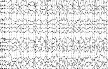 30 Epilepsi Cilt 9, Say 1, 2003 hemisferde belirgin, a r ve yayg n organizasyon bozuklu u ile solda periyodik lateralize epileptiform deflarjlar (PLED) görüldü (fiekil 4a).