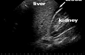 FAST (Focused Assesment with Sonografi for Trauma) FAST muayenesinde serbest sıvı için 4 alana bakılır Perihepatik & hepatorenal