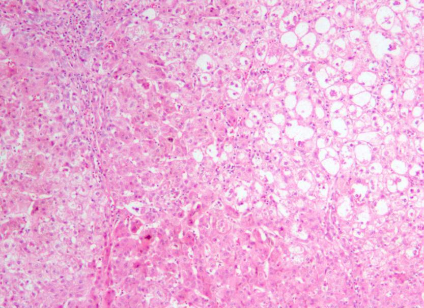 Fibröz dokunun intralobüler uzanımı ve perisinüzoidal fibrozis