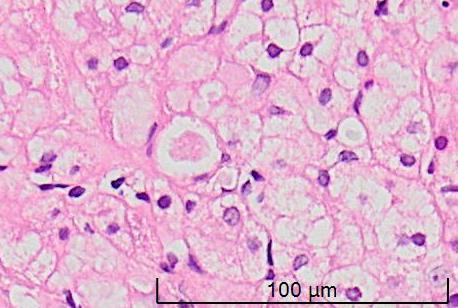 GDH Tip IV Nadir görülür Andersen hastalığı Branching enzim eksikliği sonucu amilopektin benzeri polisakkarid birikimi olur. Hepatosplenomegali bulunur. Hepatik ve nöromuskuler formları vardır.