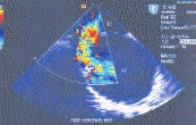 Tart flma Do umsal kalp hastal klar içinde interatriyal septum patolojileri önemli bir yer tutar.