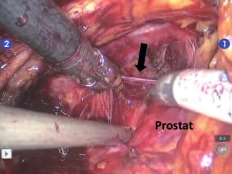 Prostat bezinin üzerindeki prostatik fasya açılır ve NVD nin lateral diseksiyonu, prostatik kapsülün üzerindeki periprostatik fasyanın ön yüzden yüksek serbestlenmesi (high anterior release) yöntemi