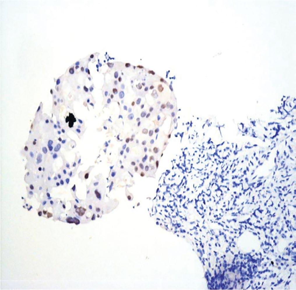 Onkositik hücrelerden baskın AciCCA tanısı alan olguda PAS pozitif, diastaz dirençli sitoplazmik granüller mevcuttur (Resim 4).