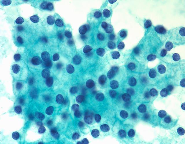 Asinik hücreli karsinomalar (AHK) hem major hem minör TB lerinde görülür.