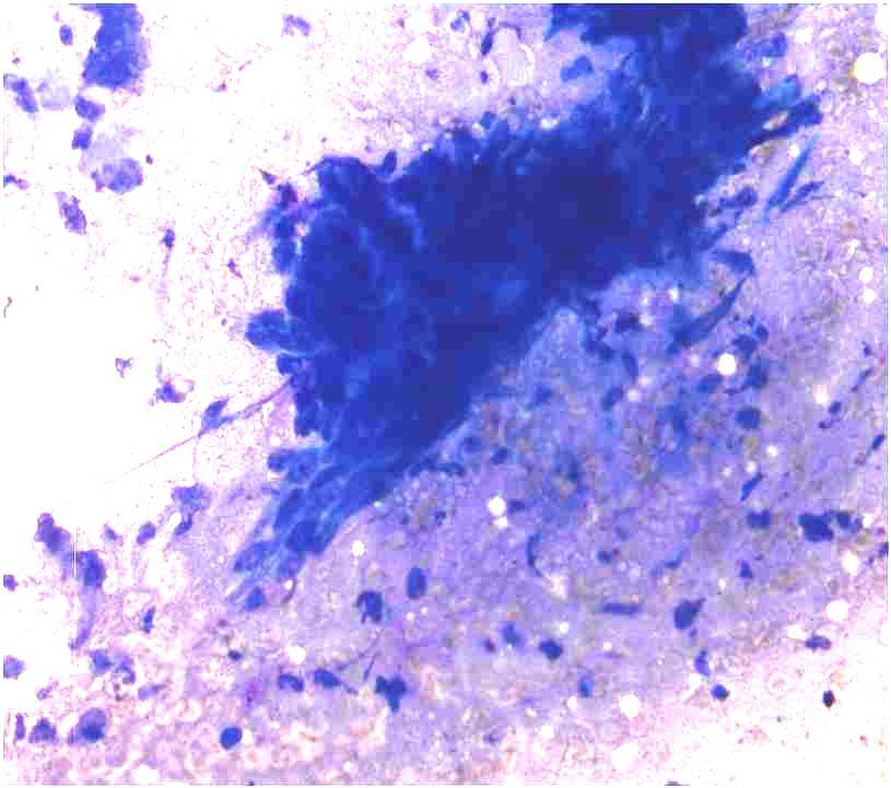 Yüksek dereceli mukoepidermoid karsinom: Sellüler yayma Üç boyutlu belirgin atipi gösteren