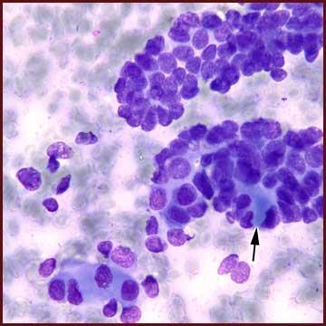 EMK Romanowsky stained smear showing a syncytial tissue fragment of myoepithelial cells enclosing spaces containing matrix material (arrow), which presents a pattern reminiscent of adenoid cystic