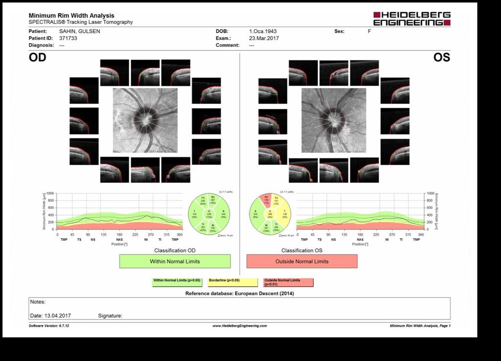 Eşit aralıklı 48 veri noktası (24 kesit) Otomatik segmentasyon algoritması Eşit aralıklı 12 bölgede ONH anatomisi BMO-MRW