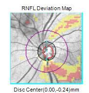 ONH ve RNFL Analizi: Disc