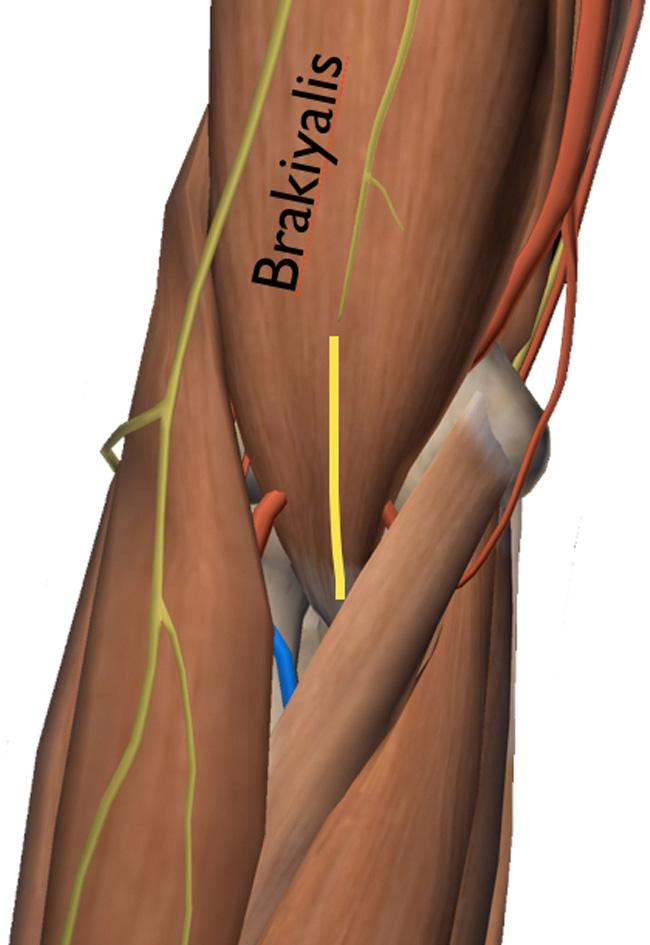 LATERAL YAKLAŞIMLAR Dirseğin belki de en çok kullanılan cerrahi yaklaşımı lateral yaklaşımdır.