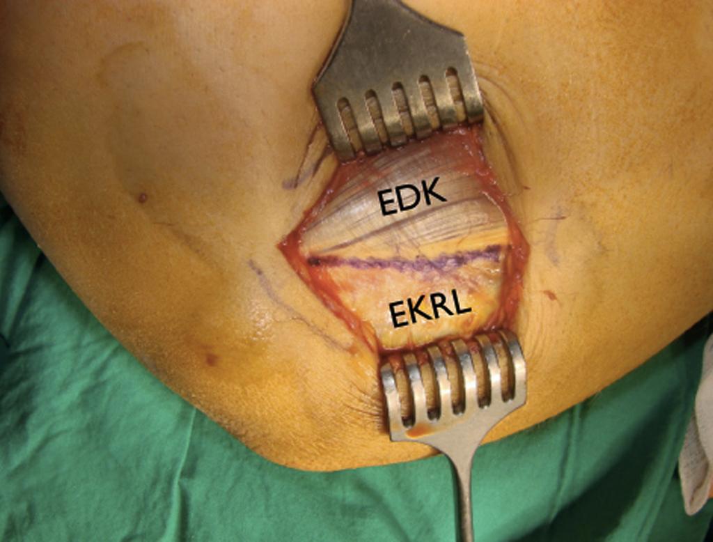 Kaplan lateral yaklaşım Lateral ulnar kollateral bağ (LUKB) kesilmeden radius başının mükemmel görüntülenmesini sağlar.