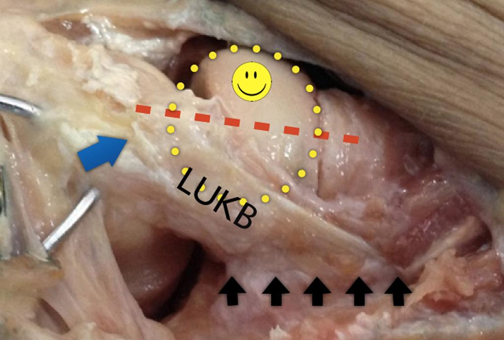 Lateral epikondilden, olekranon tipinin 5 cm distaline kadar uzanan insizyon yapılır. EKU anteriora, ankoneus posteriora ayrılır (Şekil 9).