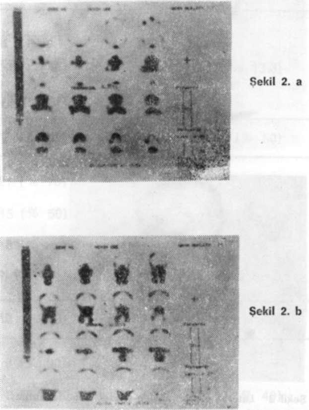 Cilt 12, Sayı 2 KARAKURUMER. ÖZEN, AYDINTUĞ, ÖZGÜVEN, OKÇU Klinik muayenesi ve radyografik incelemesi yapılan tüm bireylerde, GATA Nükleer Tıp A.B.D.'nda planar kemik sintigrafisi ve SPECT çalışıldı.