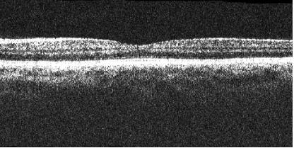 indeks farkı göz önüne alındığında retina için 10 µ luk bir rezolüsyona işaret etmektedir. Sistem standart bir slit-lamp biomikroskopa uyarlanmıştır.