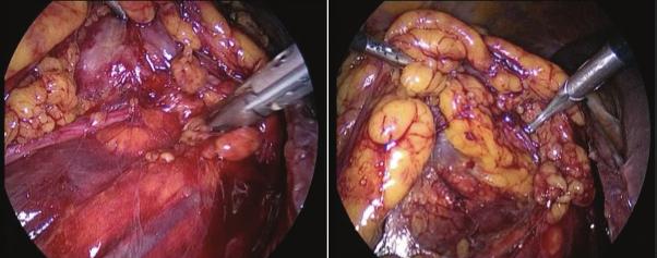 1 Laparoskopik Radikal Nefrektomi periorda karaciğer alt yüzeyi boyunca mediale doğru devam ettirilir.