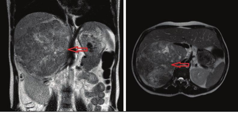 edildi (Resim 1). Kalça ağrısına yönelik yapılan MRI incelemede sakrum sağ yarımında patolojik sinyal değişikliği, ilk planda metastaz lehine değerlendirildi.