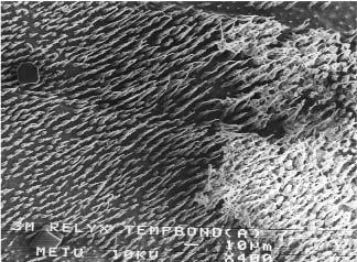 GEÇİCİ SİMANLARIN REZİN ESASLI YAPIŞTIRICILAR ÜZERİNE ETKİSİ 129 Resim 13: Dentin dokusu üzerine önce geçici Tempbond (Öjenol içeren) sonra rezin esasl adezivuygulanan bir örnekte diş sert dokular