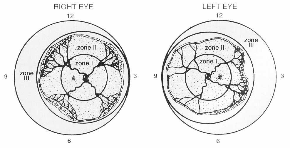 Hastalığın yayılım derecesi Sağ göz Sol göz Retinal yüzey saat kadranına benzer şekilde