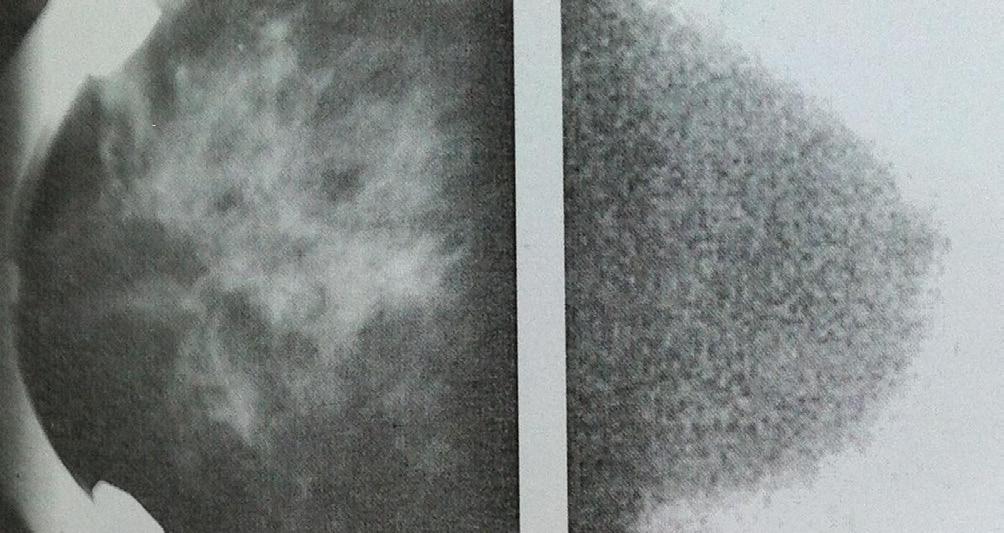 Sintimmogfinin tnı koyduduklı sınd tnısı doğulnnl, doğulnmynldn 3.4 kt dh fzl idi. Sintimmogfi ile mmogfinin mikoklsifîksyonlı değelendimesi sındki uyum ise k:0.29 (zyıf) olk hesplndı.