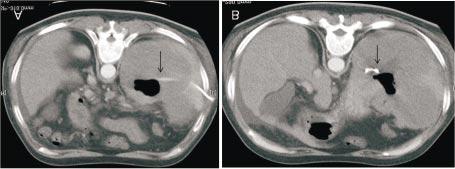 Köseoğlu ve Ark. Resim 2. A) Lenfoma dalak tutulumu olan hastada intratümöral apseye yerleştirilen drenaj kateteri izleniyor (ok). B) Apse lojunda kateterin ucu izleniyor.