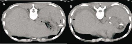 A) Safra kesesi operasyonu sonrasında apse gelişen olguda transhepatik yerleştirilen kateter izleniyor.
