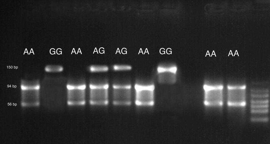 40 genotipine (mutant) sahip PZR ürünleri 150 bç büyüklüğünde tek bant halinde görünürken, homozigot AA genotipine (normal) sahip PZR ürünleri, enzim kesimi sonrası 94 bç ve 56 bç lik iki parçaya